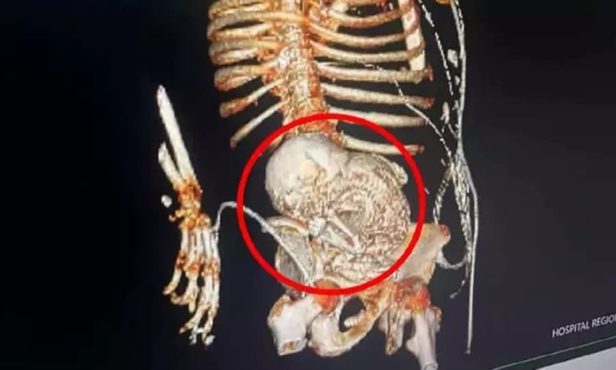 Em MS, idosa descobre feto mumificado há 56 anos dentro do próprio útero