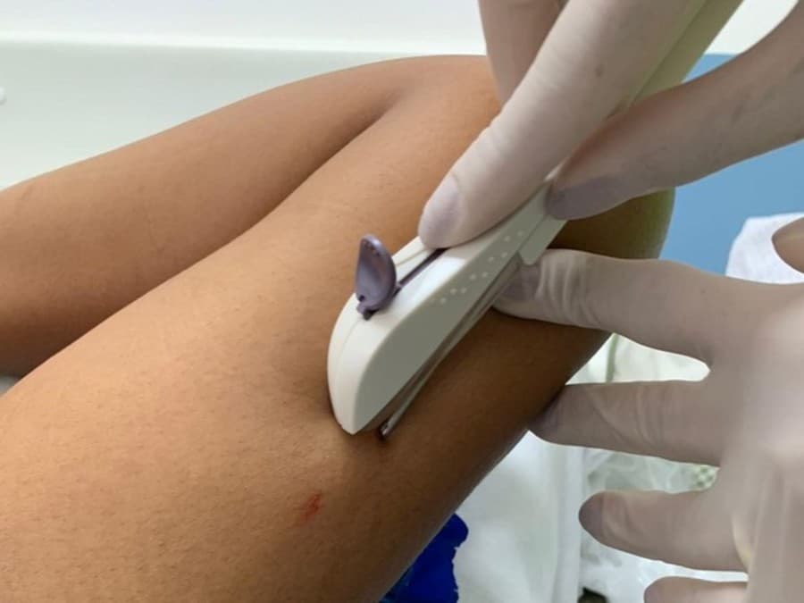 Implanon: implante contraceptivo é ofertado gratuitamente pelo SUS em Maracaju