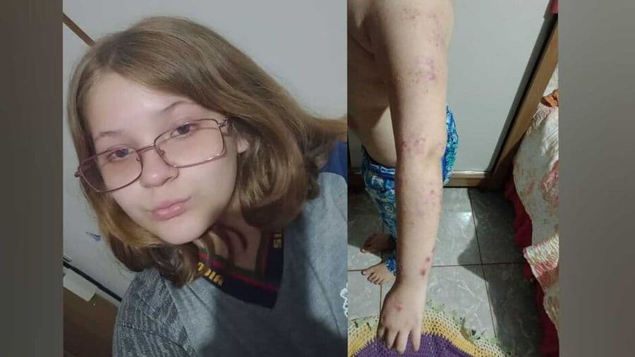Sem apoio, menina de 9 anos continua sem vacina que custa R$ 10 mil reais para tratamento de dermatite atópica