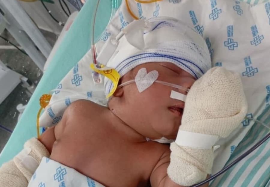 Maracajuense pede ajuda para arrecadar recursos para tratamento dos filhos diagnosticados com má-formação