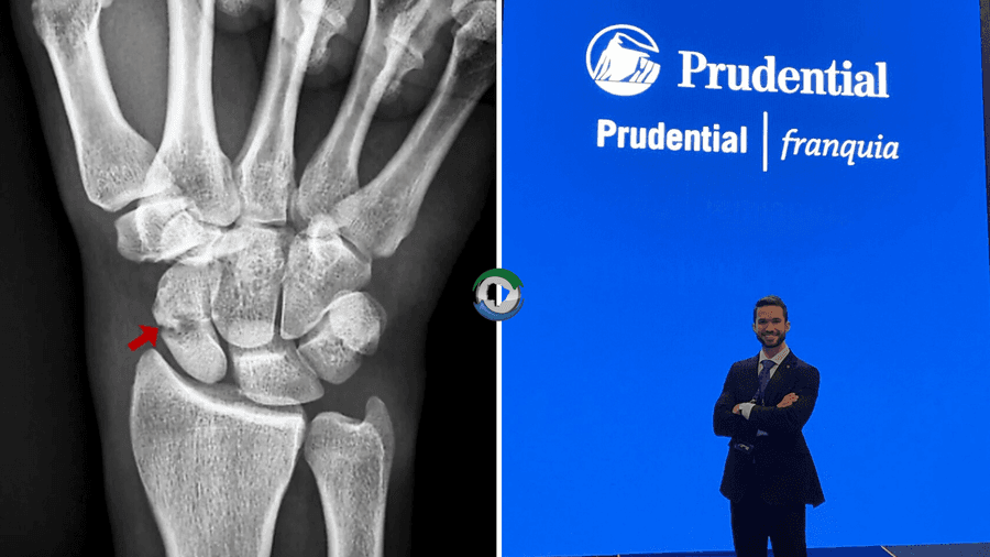Sidrolandense cai de escada, quebra punho e recebe R$ 25 mil com seguro em vida da Prudential