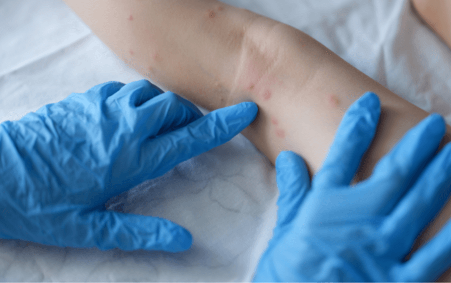 Secretaria de Saúde confirma primeiro caso de Monkeypox em Maracaju