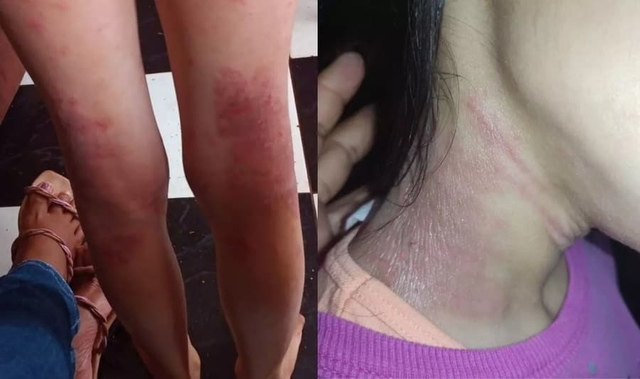 Sidrolandense cria vaquinha online para ajudar no tratamento dermatológico das filhas