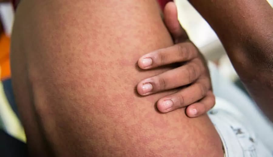 Maracaju é a segunda cidade com mais casos de Chikungunya no estado