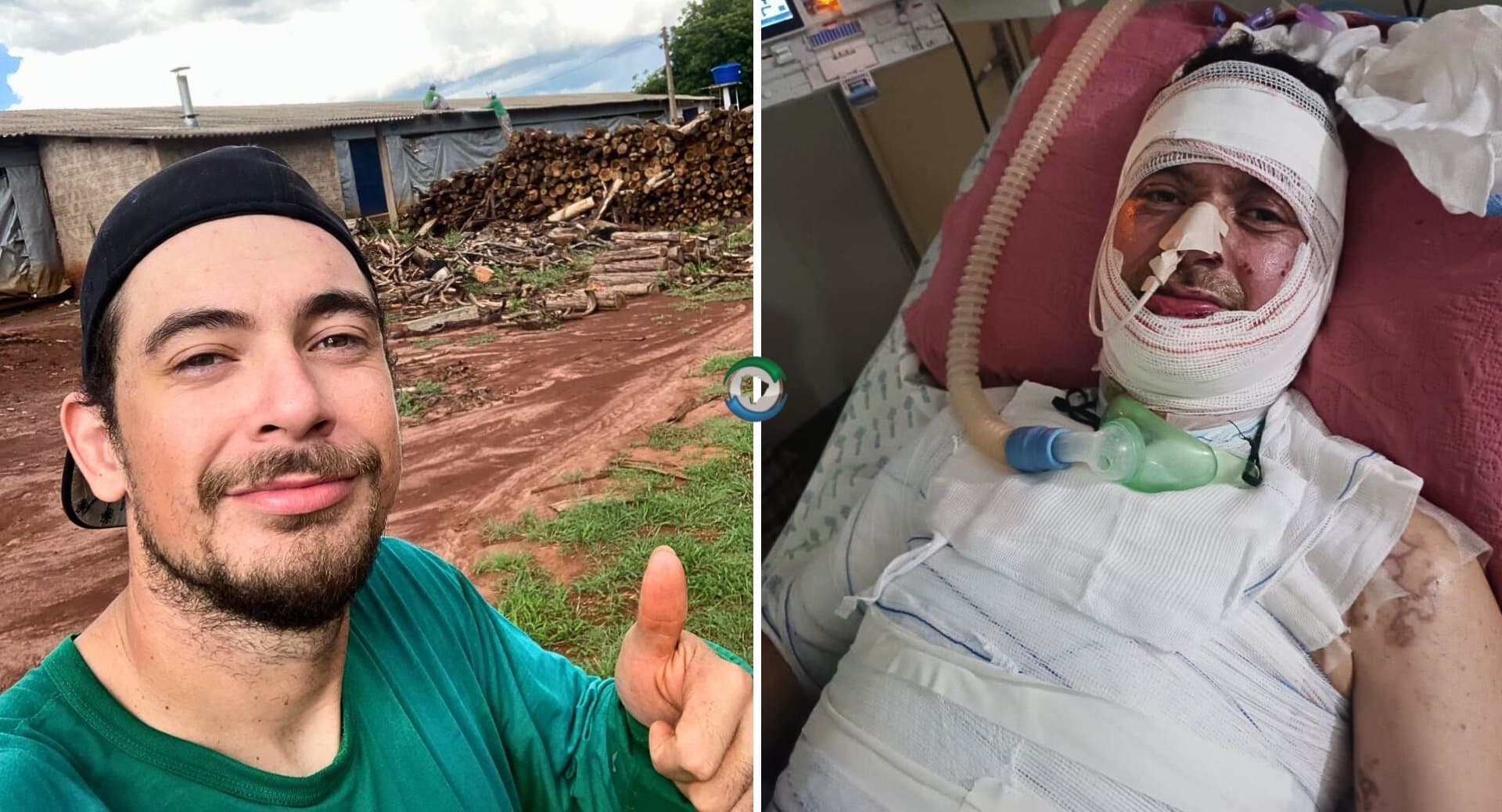 Sidrolandense de 26 anos sofre graves queimaduras e família cria rifa para viabilizar cirurgia urgente